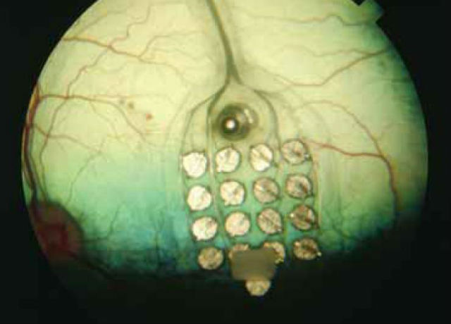 Электроды Argus II на сетчатке глаза (иллюстрация Second Sight).