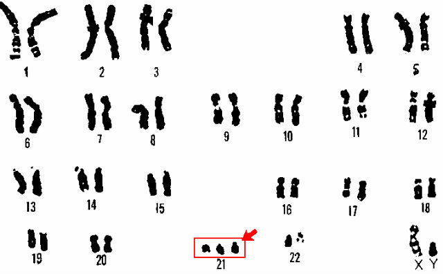 Синдром Дауна является следствием появления лишней третьей копии 21-й хромосомы (иллюстрация Wikimedia Commons). 