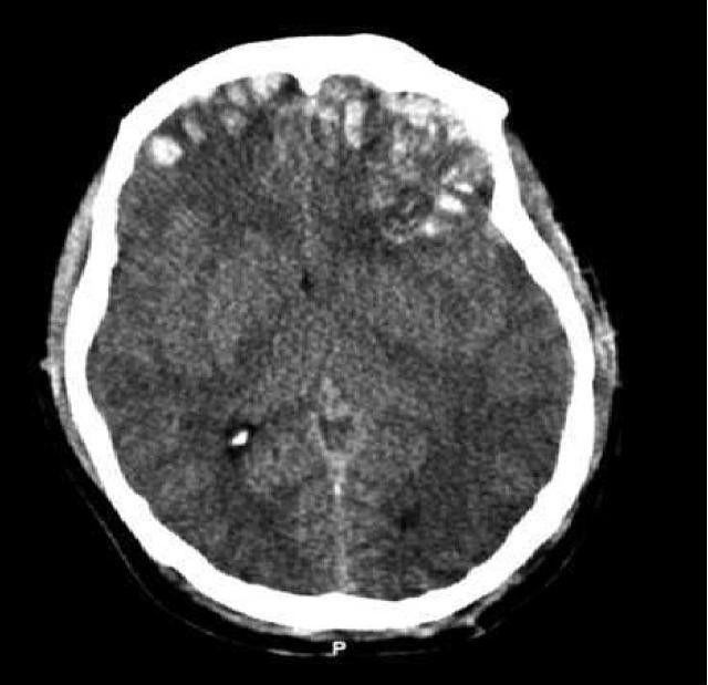 Черепно-мозговые травмы могут вызывать различного рода нарушения сознания  (фото Rehman T, Ali R, Tawil I, Yonas H/Wikimedia Commons). 