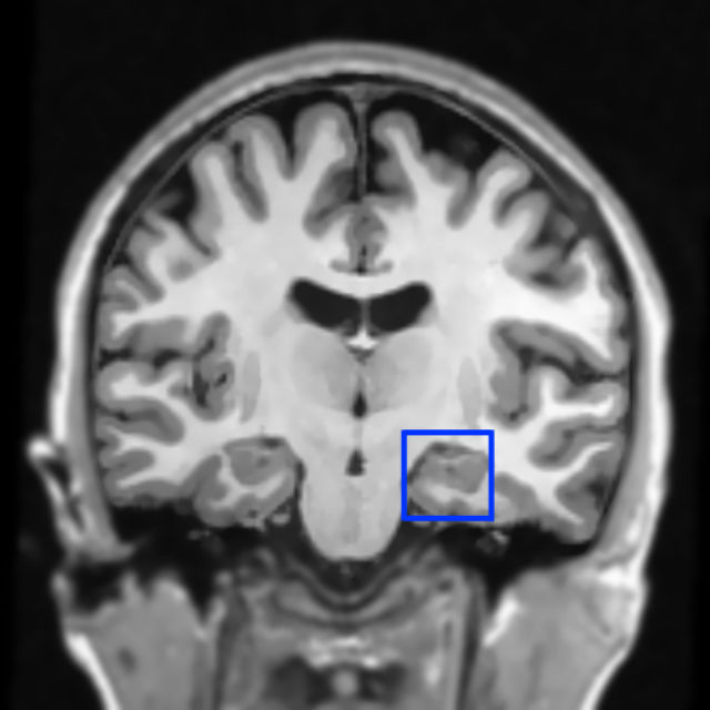 На финальном этапе эксперимента учёные заметили значительные изменения в активности нейронов гиппокампа (выделен синим квадратом) — зоны, где формируются воспоминания (фото Katherina K. Hauner). 