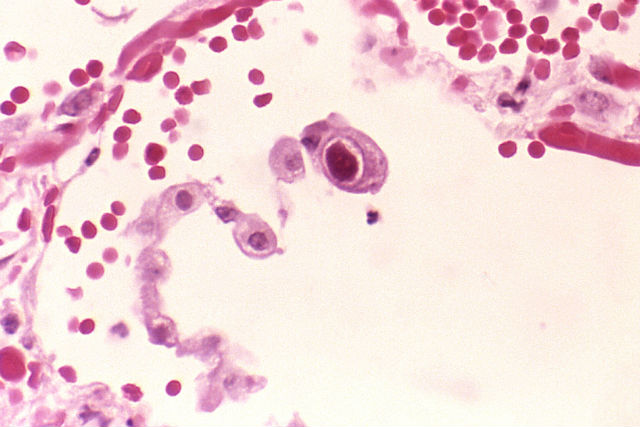 Клетки лёгкого, поражённые цитомегаловирусом (фото CDC/Dr. Edwin P. Ewing, Jr.). 