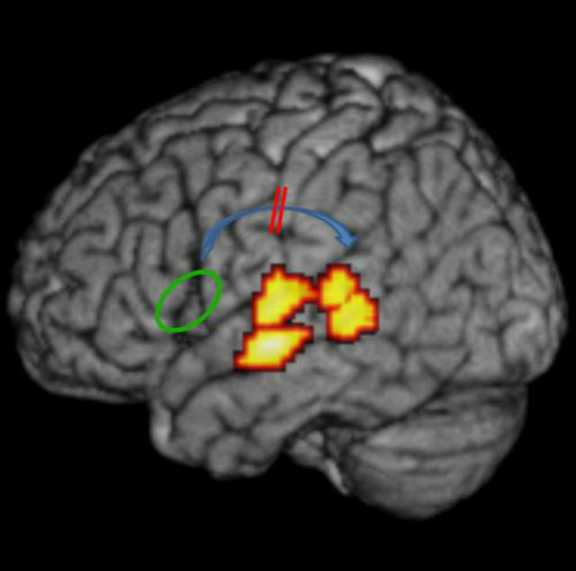У людей с дислексией нарушена связь между слуховыми областями коры головного мозга (жёлто-красные) и центром Брока, обеспечивающим моторную организацию речи (зелёный круг) (фото, иллюстрация Bart Boets). 