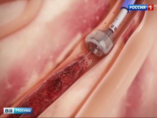 Московские хирурги спасли немецкого туриста от инсульта